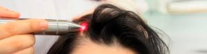 tratamiento laser instituto quirurgico capilar