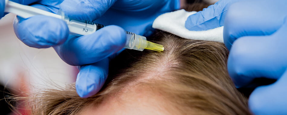 Mesoterapia capilar en Barcelona