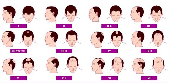 cuales son los niveles de calvicie