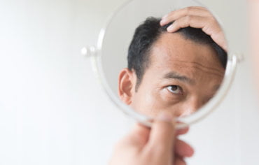 La alopecia masculina